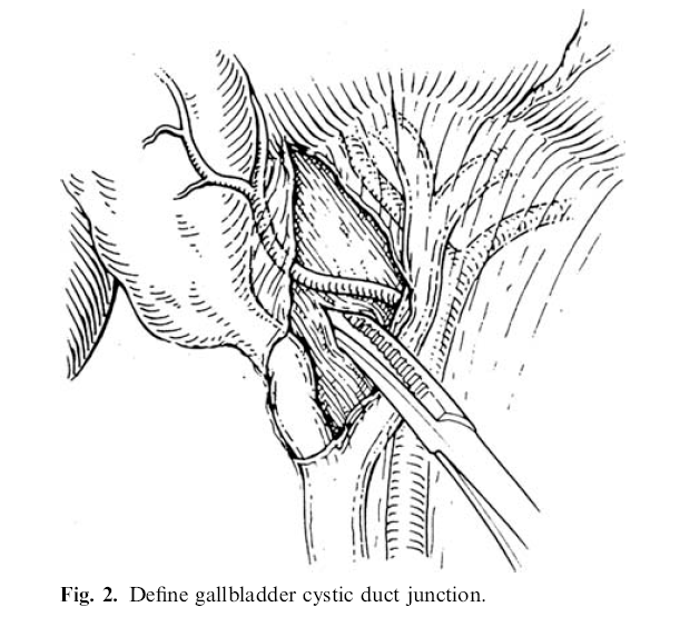 Avoiding Laparoscopic bile duct injury 31