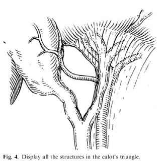 Avoiding Laparoscopic