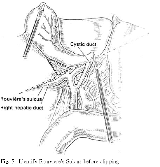 Avoiding Laparoscopic bile duct injury 35 Diagnosis of bile duct injuries 75-90% of CBD injuries are not recognized during surgery high index of suspicion jaundice biloma