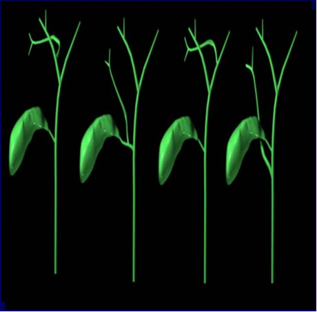 Risk Factors learning curve Conor S and Garden OJ, Br J Surg 2006 9 Risk Factors Anatomic Variations Present in 18-39% of cases Dangerous variations predisposing to BTI are present in only 3-6% of