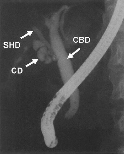 Risk Factors Anatomic Variations 11 Risk Factors IOC Routine IOC reduce the risk Fletcher DR, Ann Surg 1999 Flum DR, Arch Surg 2001 Flum DR, JAMA 2003 Bile duct injury is not