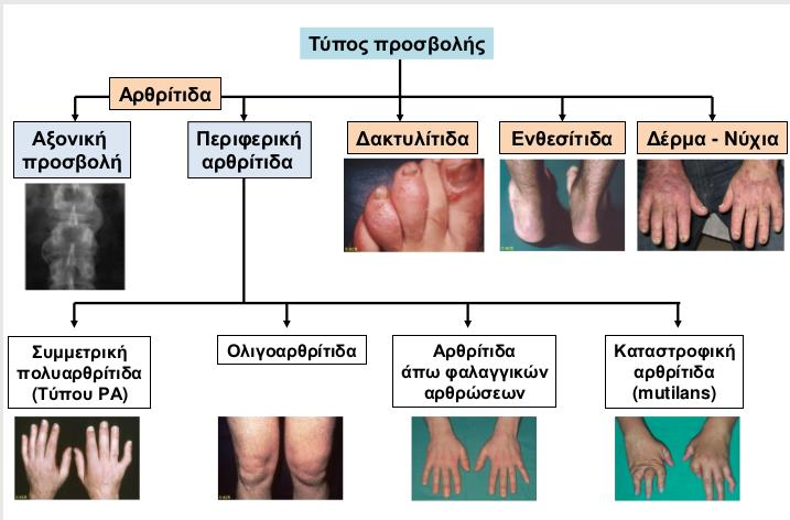 Ψωριασική Αρθρίτιδα Ετερογενής νόσος με ευρή φάσμα