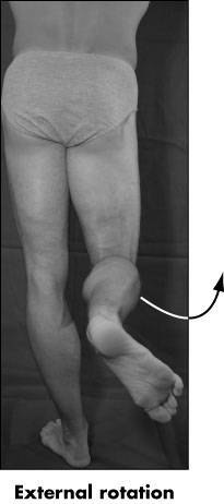 medial condyle á femur, medial meniscus og medial condyle á tibia.