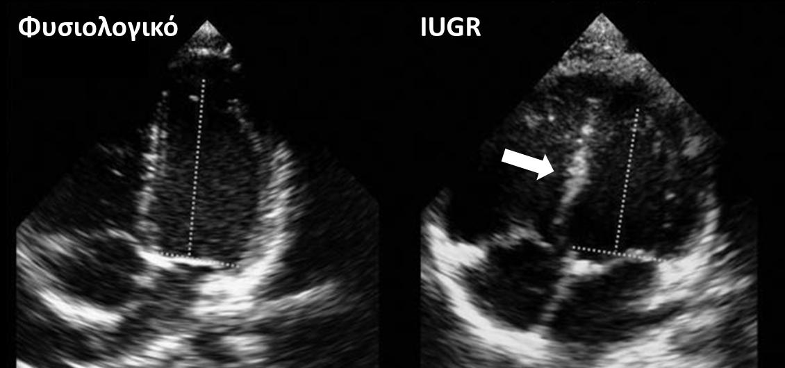 Εικόνα Ι.Β.2. Υπερηχοκαρδιογράφημα δυο διαστάσεων σε ένα νεογνό φυσιολογικής ενδομήτριας ανάπτυξης και ένα με IUGR.