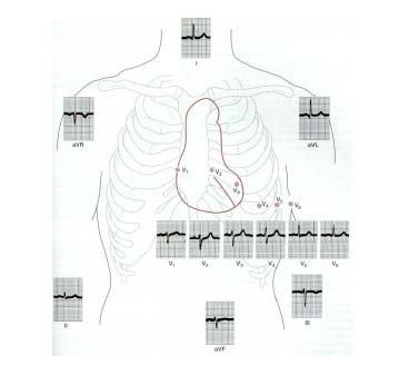 διαφορετικών ομάδων των καρδιακών μυών Το ECG