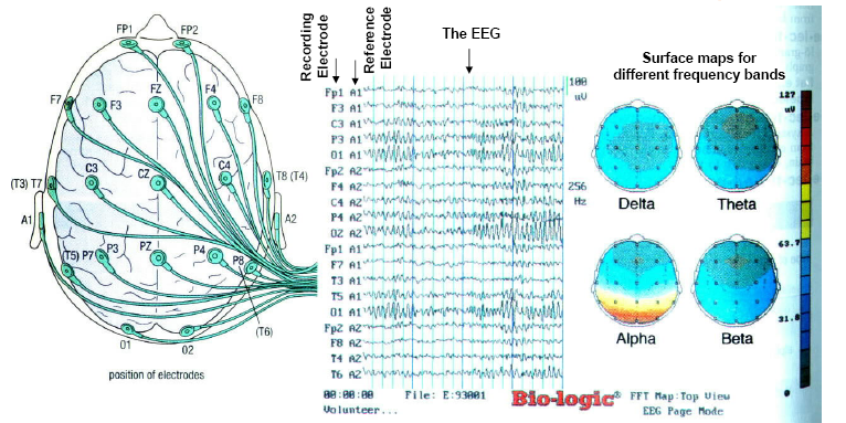 Ηλεκτροεγκεφαλογράφημα (EEG)