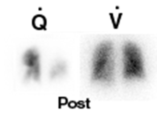 V/Q scan Ταξινομείται ως φυσιολογικό, χαμηλής πιθανότητας, ενδιάμεσης πιθανότητας (μη διαγνωστικό) και υψηλής πιθανότητας για ΠΕ διαγνωστική αξία σε συνδυασμό