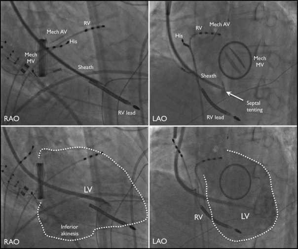 Percutaneous interventricular septal access in a patient with aortic and mitral mechanical valves: A novel technique for catheter ablation of ventricular tachycardia M Vaseghi, C Macias, R Tung,