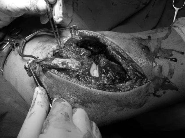 182 Ασθενής 11: Ρήξη έσω πλαγίου, προσθίου και οπισθίου χιαστού Ημερομηνία χειρουργικής