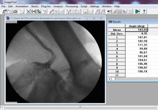 0 (1995-2002, Department of Dental Diagnostic Science at The University of Texas Health Science Center, San Antonio, Texas) και μετρήθηκε η γωνία μεταξύ των δύο σκελών της ιγνυακής αρτηρίας.