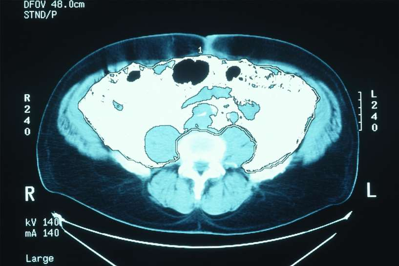 visceral fat measurement