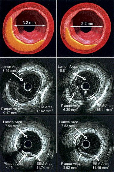 Representative cross-sectional intravascular ultrasound images of matched arterial segments at