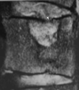 204 Απεικoνιση Αθλητικων Κακωσεων κεφαλαιο 13 Εικ. 6. Οβελιαία εικόνα μαγνητικής τομογραφίας Τ2- προσανατολισμού αναδεικνύει τραυματική ενδο-οστική κήλη του μεσοσπονδυλίου δίσκου (Schmorl s node).