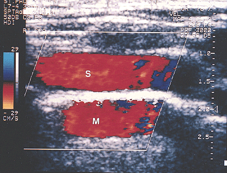 Artifact καθρέπτου σε έγχρωμη ροή (Doppler) -Η αρτηρία κοντά στην κορυφή του δεξιού πνεύμονα