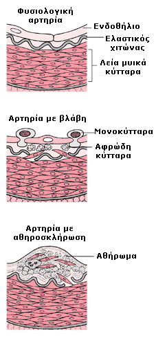 ποσότητα οξειδωμένης LDL που προέρχεται είτε από αδυναμία φαγοκυττάρωσής της από τα κορεσμένα φαγοκύτταρα, είτε από νέκρωση κορεσμένων αφρωδών κυττάρων, είτε από τον συνδυασμό και των δύο