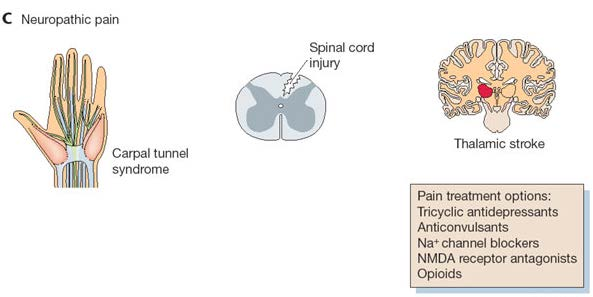 neuropatic pain Lesion in