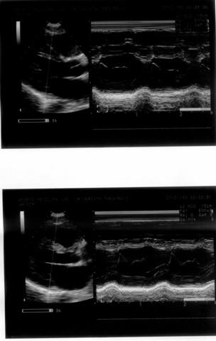 3 mm EF: 86.