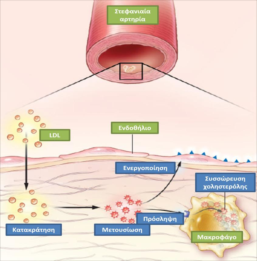 Εικόνα 1. Η κατακράτηση LDL υπενδοθηλιακά πυροδοτεί την έναρξη της αθηρογένεσης.