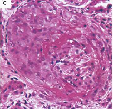 Renal lesion is a form of focal, segmental, proliferative glomerulonephritis characterized by fibrinoid necrosis, microvascular thrombi, and crescent