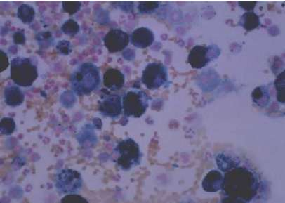 Hemosiderin-laden macrophages (darkly stained cells)