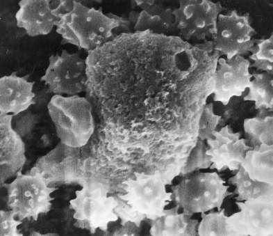 Scanning electron microscope (original magnification, 3500) showing holes in the membrane of the lung macrophage