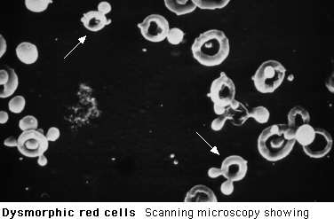 Glomerulonephritis = active