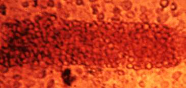 non nephrotic proteinuria