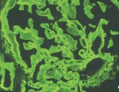 Anti-GBM disease (linear deposition of IgG) Autoimmune rheumatic