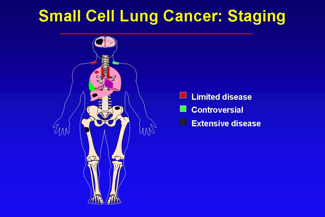 limited-stage SCLC stage I to III (T any, N any, M0) that can be safely treated with definitive radiation therapy; Extensive-stage SCLC stage IV (T any, N any, M1a/b) or T3 4 due to multiple lung