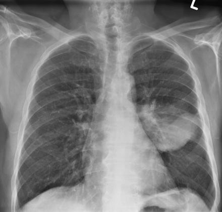 Εικόνα 2.5.: Ραδιογραφία θώρακα όπου απεικονίζεται όγκος στον πνεύμονα (αριστερό τμήμα) 2.3.2. Αξονική τομογραφία (Computed Tomography CT) Η υπολογιστική τομογραφία ή αξονική τομογραφία (CT) [25] (Εικόνα 2.