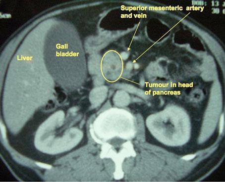 Στη CT, η λυχνία ακτίνων Χ κινείται γύρω από το σώμα του ασθενή και εκπέμπει λεπτή δέσμη ακτινοβολίας.