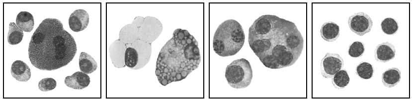 Εικόνα 1 Μορφολογικές παραλλαγές σε φυσιολογικά και νεοπλασµατικά πλασµατοκύτταρα Κύτταρο Mott, σωµάτια Κυτταροπλασµατικά ιπύρηνη και πολυπύρηνη Πλασµαβλαστικές Russel και Dutcher κενοτόπια και