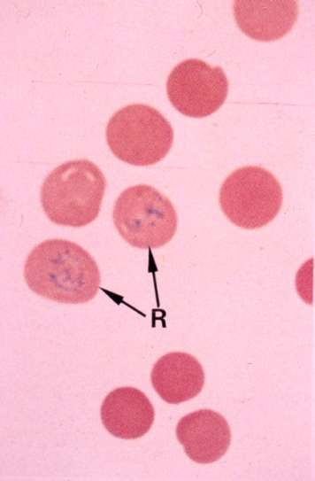 Δικτυοερυθροκύτταρο Δεν διακρίνονται στο ΦΜ από τα ώριμα ερυθροκύτταρα εκτός εάν χρησιμοποιηθούν έμβιες χρωστικές, όπως το κυανό του κρεζυλίου.