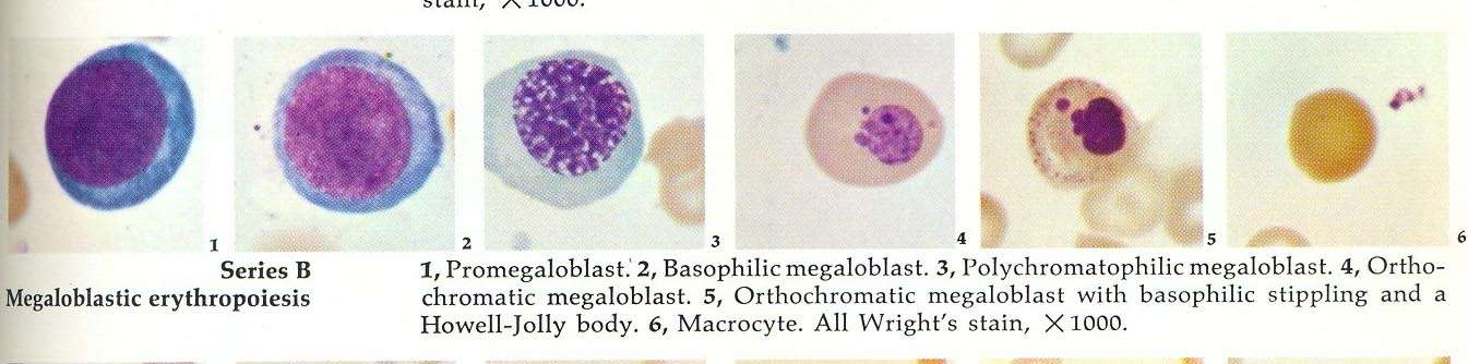 Μεγαλοβλαστική αναιμία (μακροκυτταρική αναιμία) Υπερπλαστική ερυθροβλαστική σειρά με μεγαλοβλαστικές αλλοιώσεις, σωμάτια
