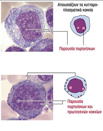 1.Μυελοβλάστη -- Μεγάλη σε μέγεθος, ο πυρήνα ς κατέχει το μεγαλύτερο τμήμα του κυττάρου, εμφανή πυρήνια. Στο ΦΜ παρόμοια μορφολογία με την προερυθροβλάστη. 2.