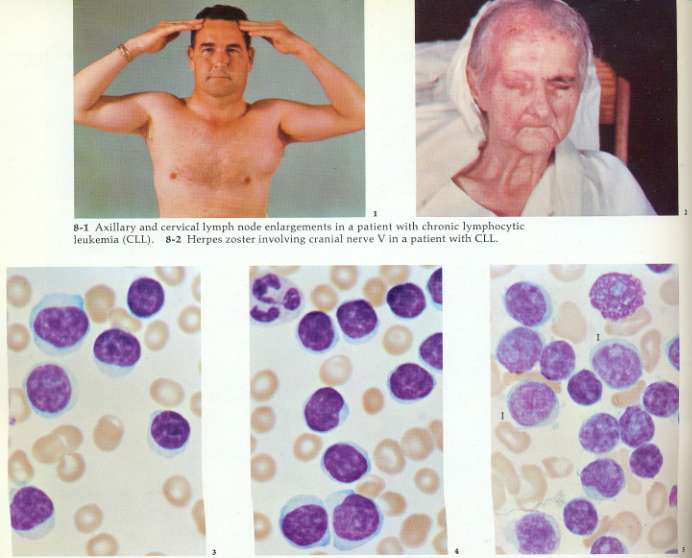 1.Διόγκωση μασχαλιαίων και αυχενικών λεμφαδένων ασθενούς με χρόνια λεμφοκυτταρική λευχαιμία. 2.