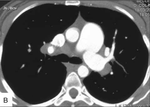 Pulmonary Veno-Occlusive Disease Septal lines Ground glass opacities