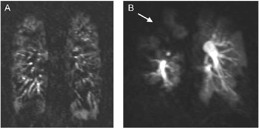 MRI pulmonary perfusion studies IPAH CTEPH Ley S, et al.