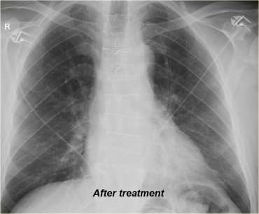 Pulmonary venous