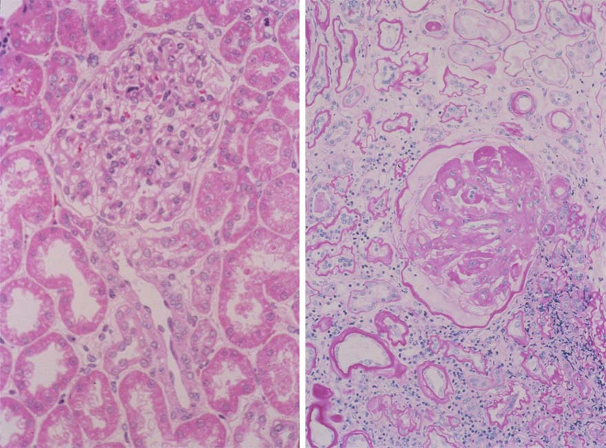 Pathology Expansion of mesangial matrix with diffuse and nodular glomerulosclerosis (Kimmelstiel-Wilson nodules) Thickening of glomerular and