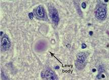 ΑΝΟΙΑ ΣΩΜΑΤΙΩΝ LEWY Παθολογοανατομία Άθροιση σωματίων Lewy μέσα στους νευρώνες.