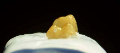 Figure 3. Artificial periodontal model applied in a first mandibular molar. 3mm of root-end remained uncovered to facilitate root-end resection. 3.3 Apical root-end procedures 3.