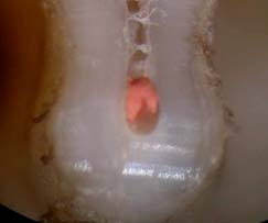 All isthmuses showed unsealed areas between the root canal sealer, gutta percha and dentine walls, regardless the type of the isthmus, observations that are in agreement with other authors and