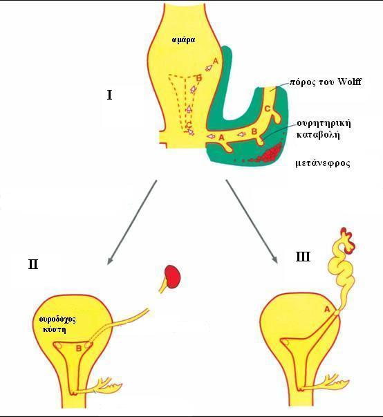 ουρητηρικής καταβολής από τον µεσονεφρικό πόρο συµβεί πιο ραχιαία (θέση III της Εικ.2), τότε το ουρητηρικό στόµιο θα βρεθεί σε έκτοπη θέση.