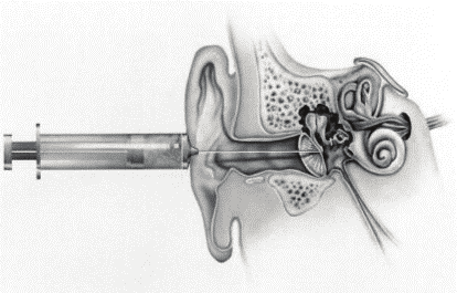 παρακάμψουν εξολοκλήρου το μέσο ους και να μεταφέρουν την επιθυμητή ποσότητα φαρμάκου απευθείας στον κοχλία.