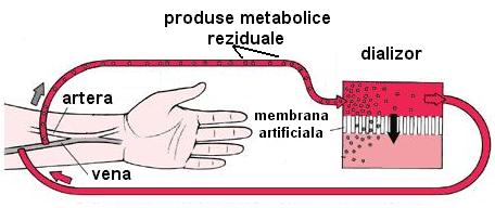 Fig. 7 Desfăşurarea hemodializei Sângele este filtrat prin dializă care foloseşte o membrană din plastic, semipermeabilă, care permite particulelor de dimensiuni mici, cum ar fi molecule sau ioni, să