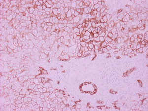 αυτές, 6 είχαν περιορισμένο αριθμό θετικών κυττάρων, 2 μέτριο και 21 μεγάλο αριθμό. Εικόνα 13: Χρόνια ηπατίτιδα C.
