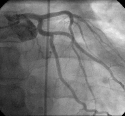 artery; the longer the blush