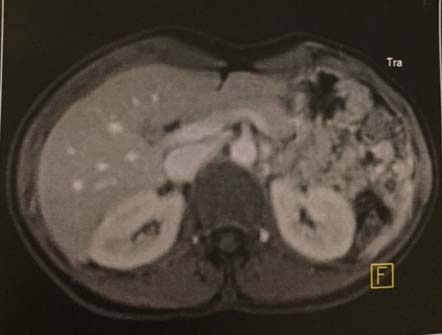 MRI άνω κοιλίας Ο ΑΡ νεφρός απεικονίζεται με φυσιολογική μορφολογία.