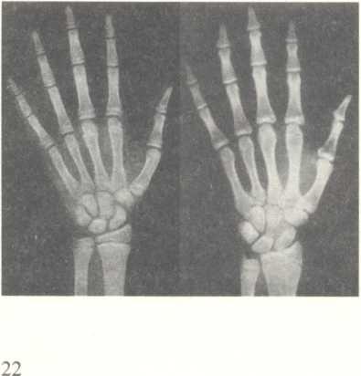 Μέθοδος οστικής Πυκνότητας Το αριστερό χέρι αντιστοιχεί σε